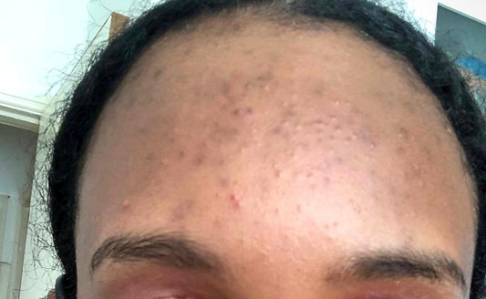 Close-up of forehead with acne, small bumps and textured skin on dark skin tone