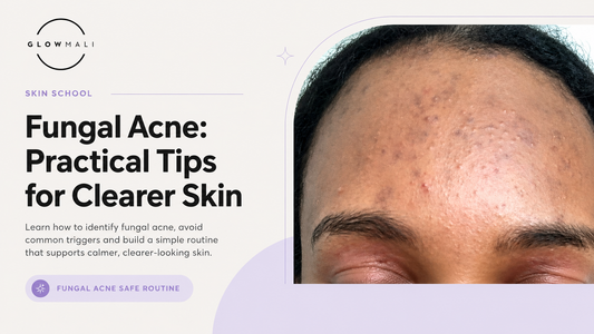 Premium Glowmali skincare blog hero banner featuring real fungal acne texture on forehead skin with educational editorial design and practical fungal acne skincare tips for clearer-looking skin.