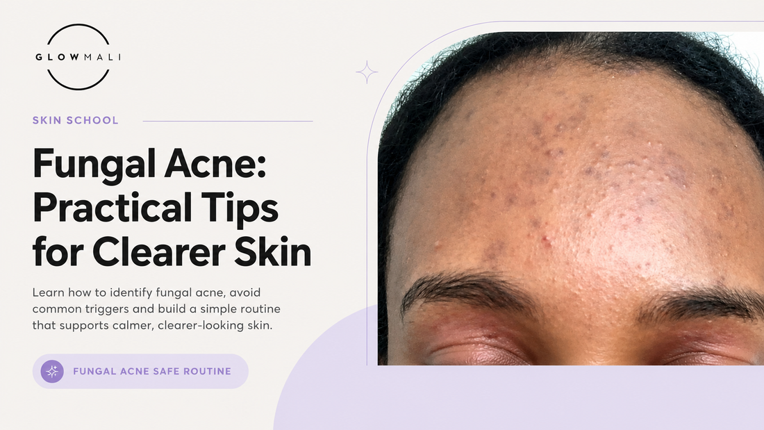 Premium Glowmali skincare blog hero banner featuring real fungal acne texture on forehead skin with educational editorial design and practical fungal acne skincare tips for clearer-looking skin.