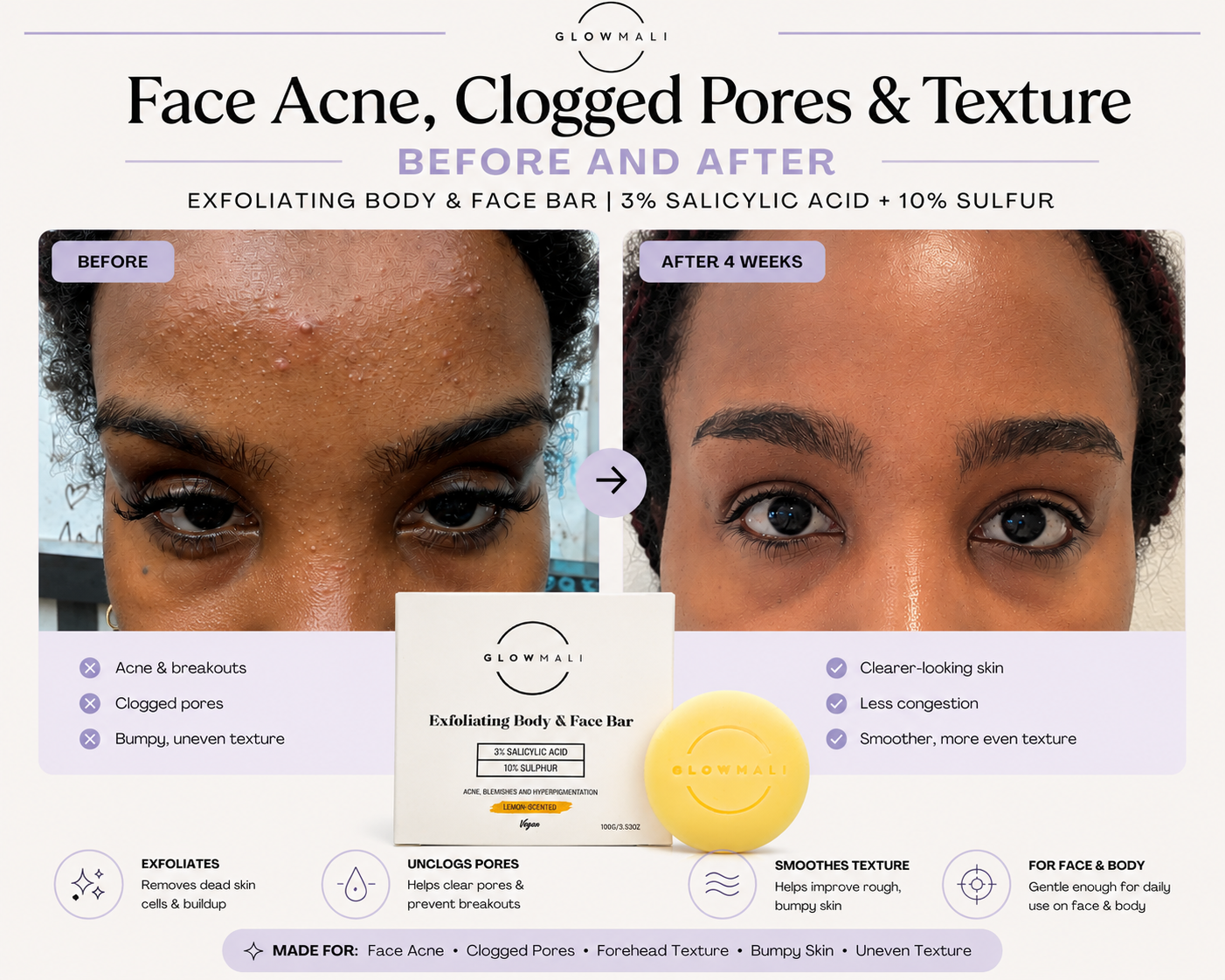 Before and after results using Glowmali Exfoliating Body and Face Bar for face acne, clogged pores and textured skin