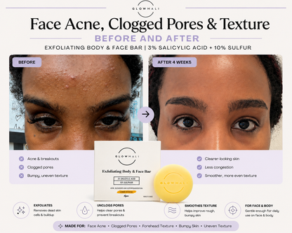 Before and after results using Glowmali Exfoliating Body and Face Bar for face acne, clogged pores and textured skin