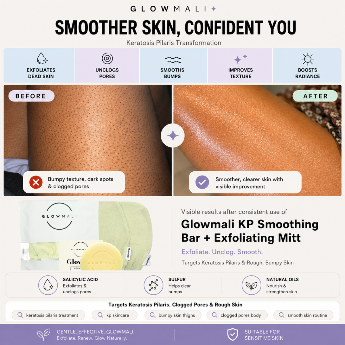 Before and after keratosis pilaris transformation using Glowmali KP Smoothing Bar and Exfoliating Mitt for smoother skin and unclogged pores